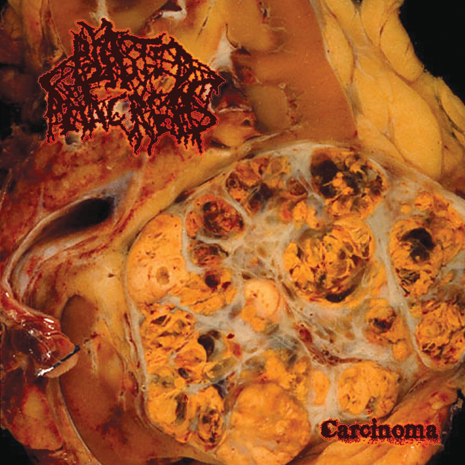 Blasted Pancreas - Carcinoma (Red Vinyl)
